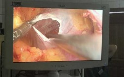 膀胱囊肿手术过程（膀胱囊肿开窗手术）