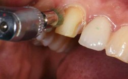 牙齿粘贴面过程（牙科粘贴面的操作流程视频）