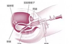 宫腔镜疏通输卵管过程（宫腔镜疏通输卵管手术费用多少）