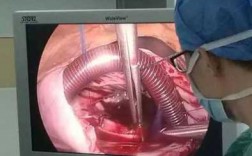 心脏开胸手术过程视频（心脏开胸手术全过程）