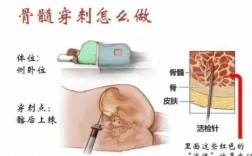 新生儿骨髓穿刺术过程（婴儿骨髓穿刺对身体的危害有多大）
