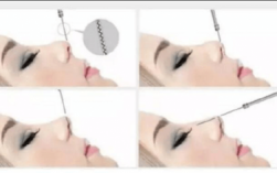 鼻尖埋线过程图片（鼻尖埋线过程图片视频）