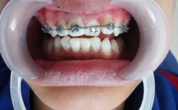 牙齿矫正的过程图片（牙齿矫正的过程会出现什么问题）