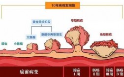 肠癌的变化过程（肠癌的变化过程图）