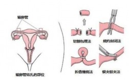 输卵管结扎过程（输卵管结扎过程中疼吗）