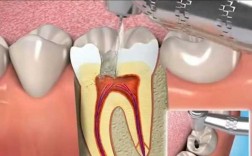 冶牙齿整个过程视频（给我看一下治牙的过程）