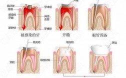 死髓牙根管治疗过程（死髓牙的根管治疗）