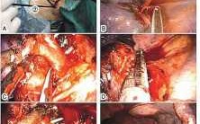 肺癌手术过程图片（肺癌手术操作流程）