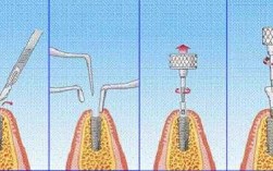 牙移植过程（牙移植术步骤）