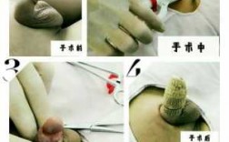 传统包皮手术过程（传统包皮手术恢复过程图）