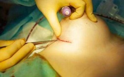 割乳房过程（切除乳房手术过程）