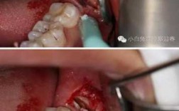 拔牙创骨愈合过程（拔牙创骨愈合过程图片）