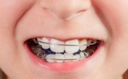 儿童牙齿矫正过程（儿童牙齿矫正过程痛不痛呀多少钱）
