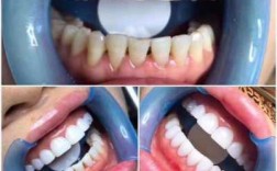 美牙的过程（美牙的步骤的视频教程）