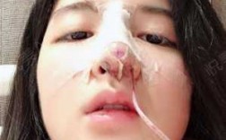 假体隆鼻过程图片（假体隆鼻过程图片真实）
