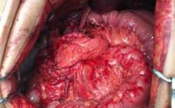 激光治疗胃癌过程（胃癌激光手术是做什么部位）