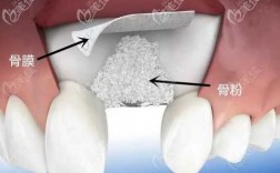 牙打骨粉过程（牙齿骨粉填充多久愈合好）
