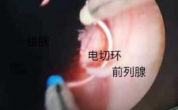 前列腺手术全过程视频（前列腺手术过程演示）