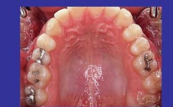 口腔粘膜恢复过程（口腔粘膜恢复过程图片）