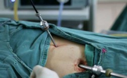 腹腔镜阑尾炎手术过程（腹腔镜阑尾炎手术过程中能看到哪些其他器官）
