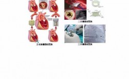心瓣膜修复术过程（心瓣膜修复术过程图解）