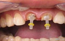 牙齿打桩的过程（牙齿打桩操作流程）