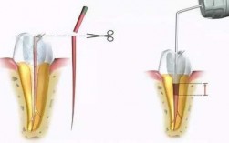 牙齿打桩过程（牙齿打桩过程动画图）