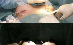 女性隆胸手术过程视频（女士隆胸手术）