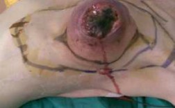 乳癌切除过程（乳癌切除过程图片）