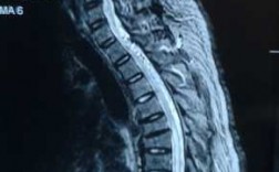 脊髓造影过程（脊髓造影过程图片）