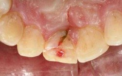 牙床骨折修复过程（牙床骨折修复过程图片）