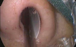 鼻粘膜划痕术过程（鼻黏膜划伤）