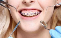 绑牙齿的过程（绑牙齿过程要多久）