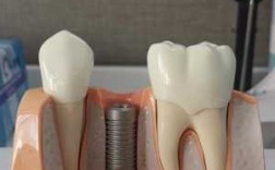 种植牙成型过程（种植牙的模型）