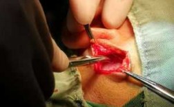 鼓膜手术过程（鼓膜手术过程视频）