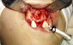 牙瘤手术过程（牙瘤做手术）