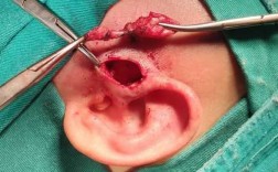 耳前瘘管手术过程（先天性耳前瘘管手术过程）