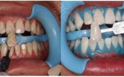 牙齿漂白凝胶漂白过程（牙齿漂白凝胶漂白过程图片）