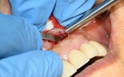 牙根尖刮治过程图（牙根尖搔刮术）