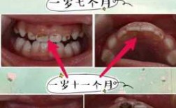 牙齿龋坏过程的图片（牙齿龋坏发展过程图片）