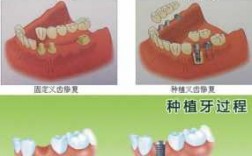 装假牙的过程说说（装假牙的过程说说文案）