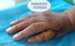 移植手指康复过程（移植手波）