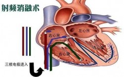 心脏的过程（心脏过程射频消融）