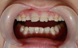 牙齿发育过程（牙齿发育不良）
