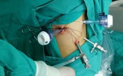 腔镜手术过程（腔镜手术过程中气腹压流量防止肿瘤）