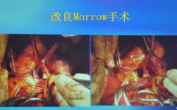 morrow术过程（morrow手术）