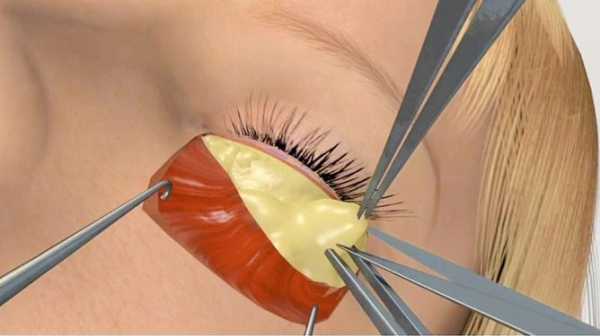 3d包裹去眼袋的过程（去眼袋手术3d视频全过程视频）-图2