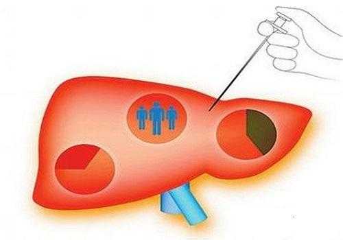 肝活检完整过程（肝活检完整过程是什么）-图2