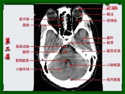 头颅ct检查过程（头颅ct检查哪些部位）-图3