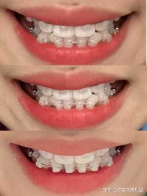 套牙套的过程（套牙套的过程需要多久）-图2
